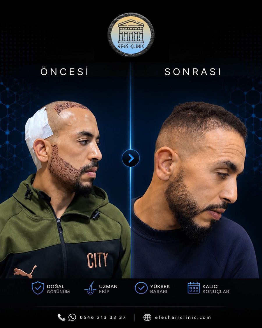 Efes Clinic İzmir saç ekimi öncesi sonrası