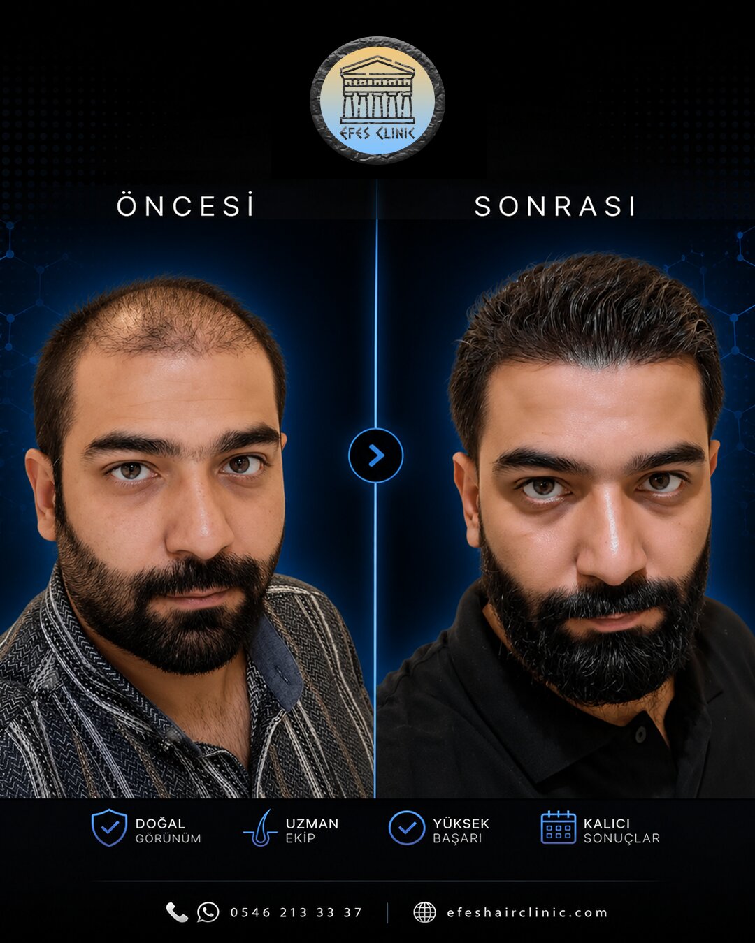 Efes Clinic İzmir saç ekimi öncesi sonrası