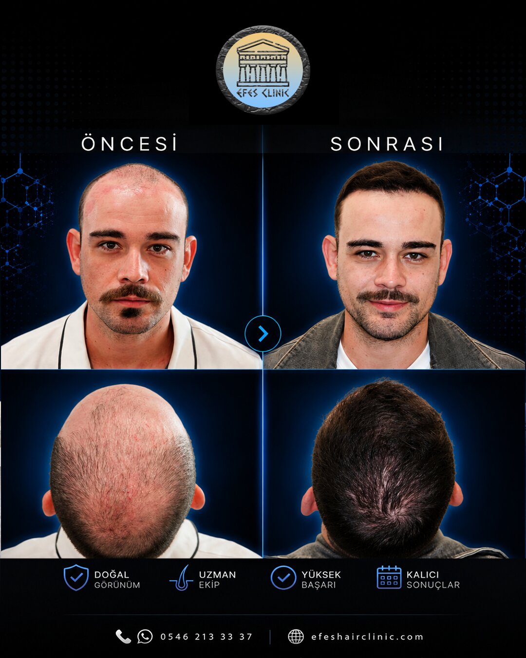Efes Clinic İzmir saç ekimi öncesi sonrası