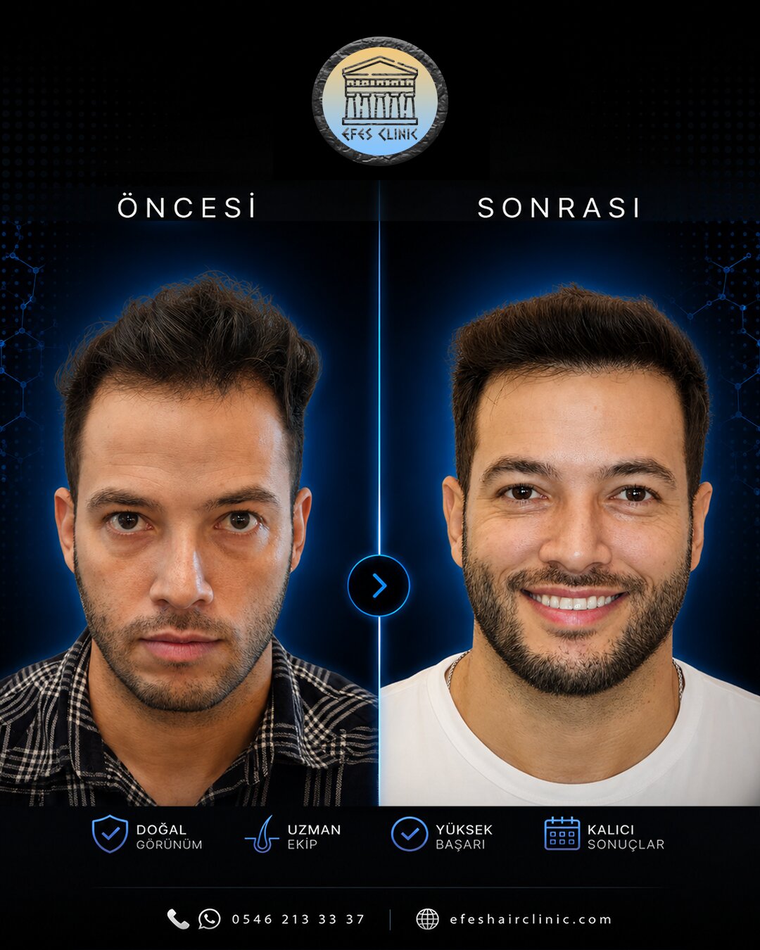 Efes Clinic İzmir saç ekimi öncesi sonrası