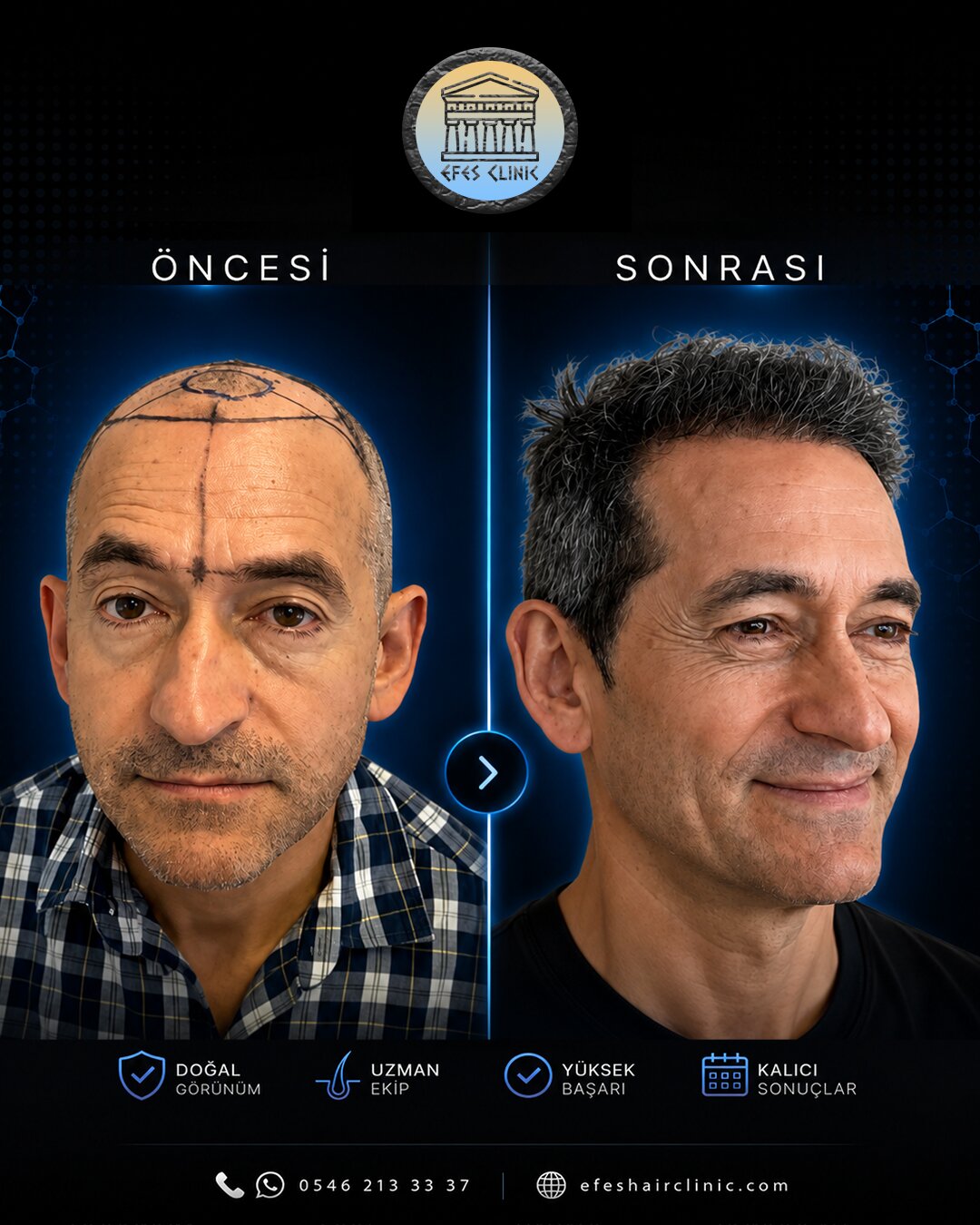 Efes Clinic İzmir saç ekimi öncesi sonrası