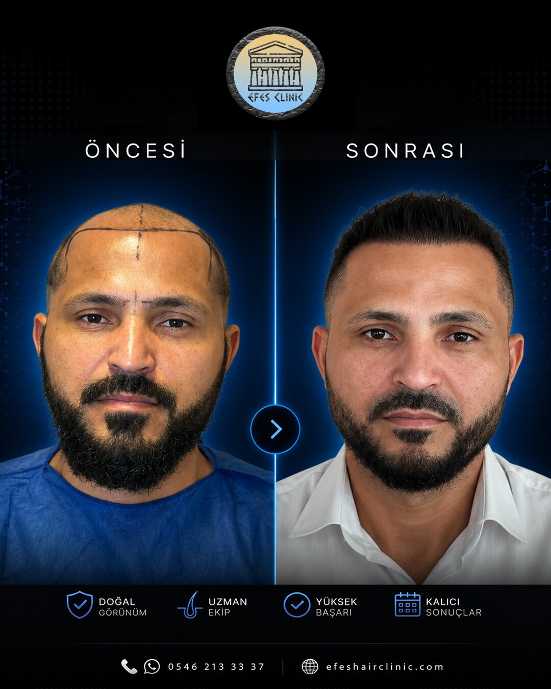 Efes Clinic İzmir saç ekimi öncesi sonrası