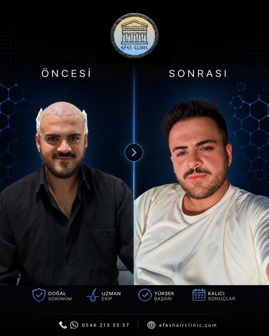 Efes Clinic İzmir saç ekimi öncesi sonrası