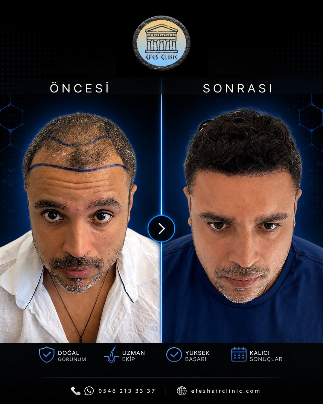 Efes Clinic İzmir saç ekimi öncesi sonrası
