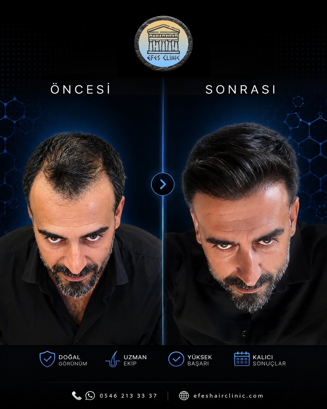 Efes Clinic İzmir saç ekimi öncesi sonrası