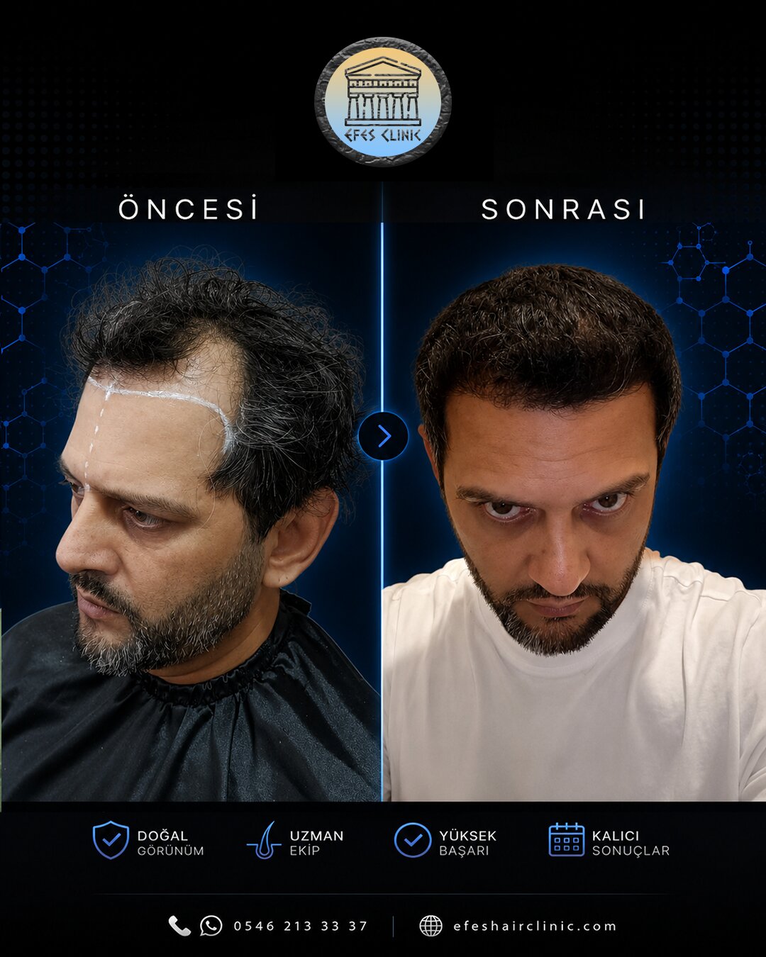 Efes Clinic İzmir saç ekimi öncesi sonrası